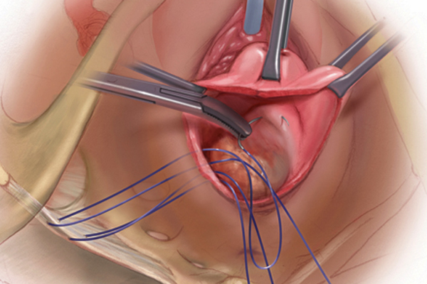 Best Uterus Removal Surgery in vasant vihar